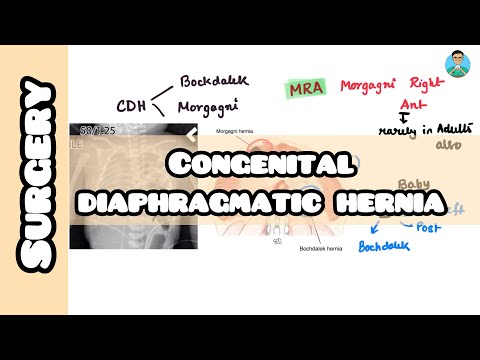Congenital Diaphragmatic Hernia: Bochdalek VS Morgagni ( with mnemonic)