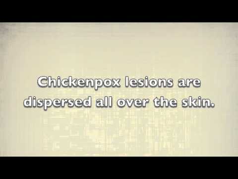 comment soigner hsv2