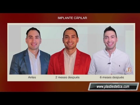 El Implante Capilar: La técnica definitiva contra la calvicie El Implante Capilar: La técnica definitiva contra la calvicie