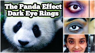 What Is The Panda Effect In Humans? Dark Eye Circles/Rings. Hyperpigmentation Around The Eyes.