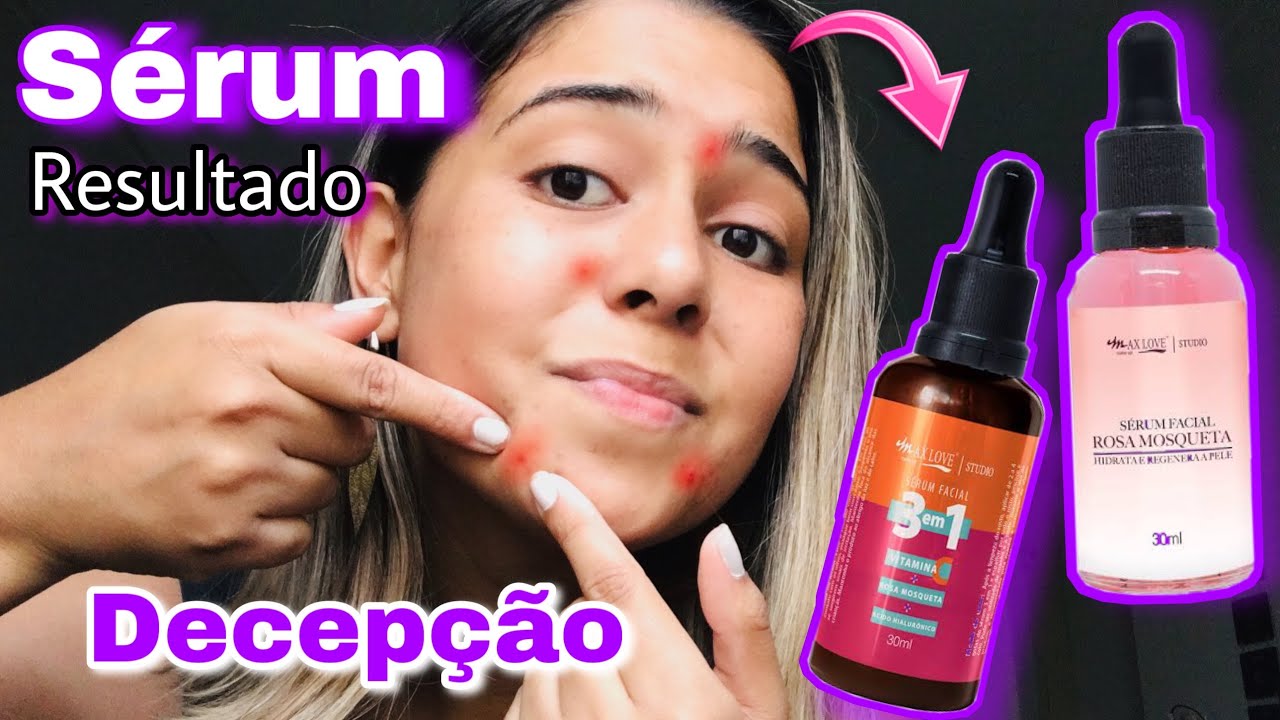 Watch Now RESENHA DOS SERUNS DA MAX LOVE | ROSA MOSQUETA E 3 EM 1 | RESULTADO DE MESES USANDO! RESENHA DOS SERUNS DA MAX LOVE | ROSA MOSQUETA E 3 EM 1 | RESULTADO DE MESES USANDO!