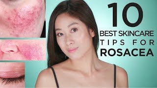 10 Best Skin Care Tips for Rosacea | Vivienne Fung