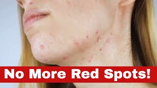 Quick & Easy: How to Get Rid of Red Spots on Face FAST!