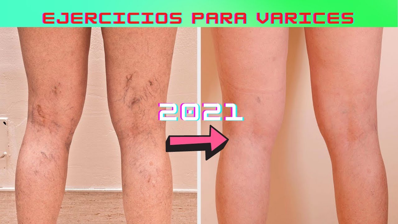 La mejor rutina para tratar las varices en piernas