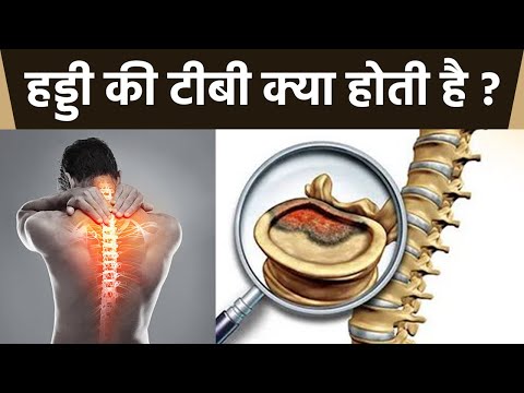 हड्डी की टीबी क्या है । हड्डी की टीबी के कारण और लक्षण । Boldsky *Health