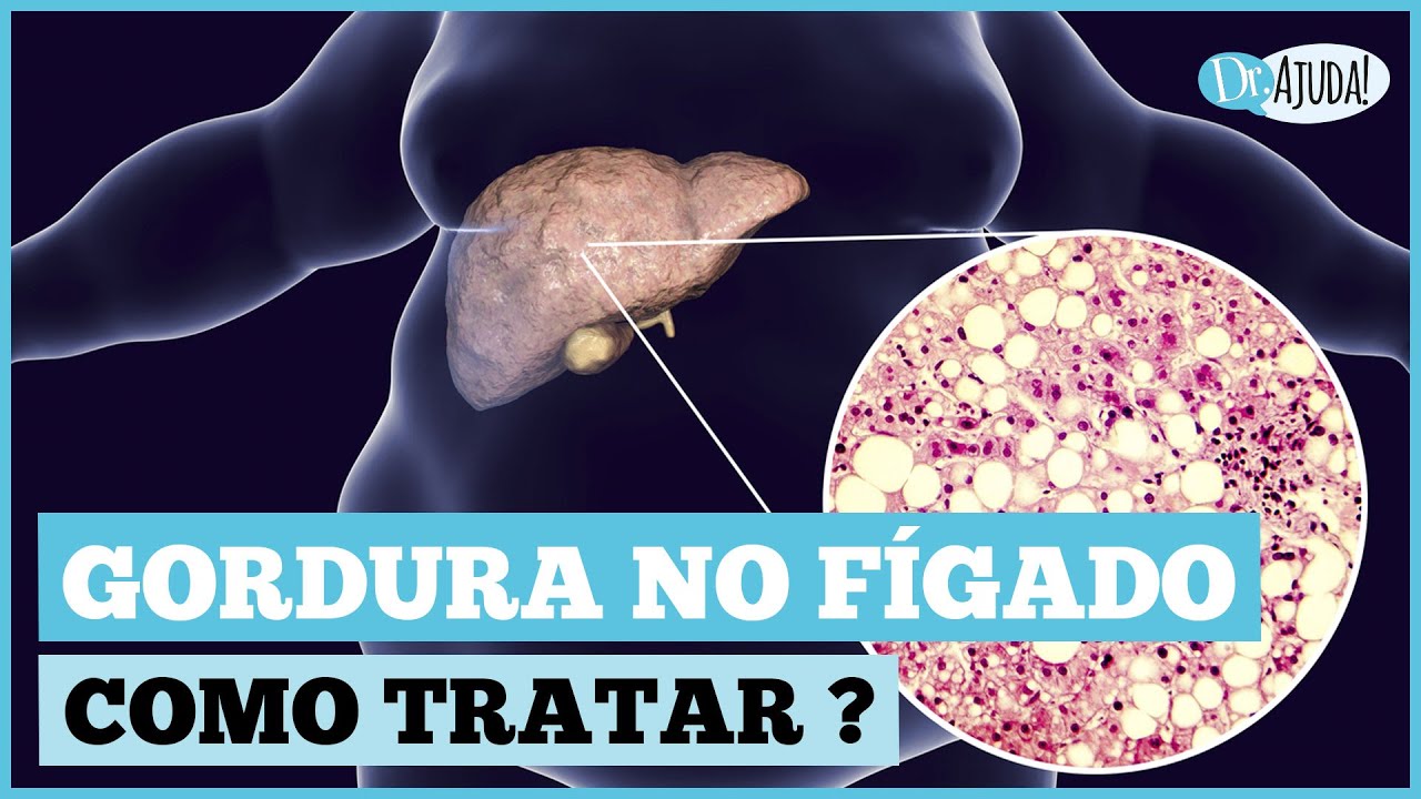 COMO DIMINUIR  A GORDURA NO FÍGADO? O QUE FAZER ?
