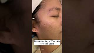 Microneedling plus TCA 15% peel for Acne Scars #Shorts