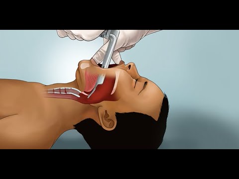 Intubation trachéale chez l'enfant