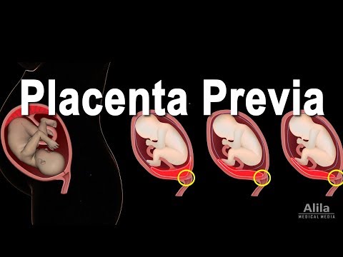 Tiefliegende Plazenta - Placenta praevia, Animation