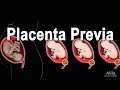 Low Lying Placenta - Placenta Previa, Animation
