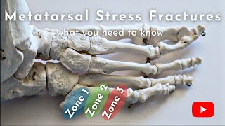 Metatarsal Stress Fractures | Causes, Diagnosis, & Treatment