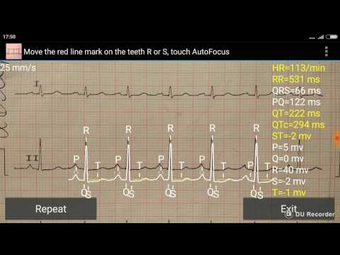 ECG Reader 2 free Video