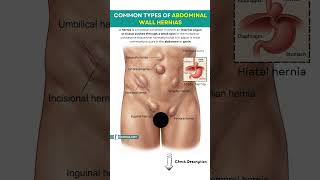 Common Types of Abdominal Wall Hernias | Hernia Types