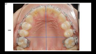 Tip lâm sàng di xa R6 một bên với Quad helix