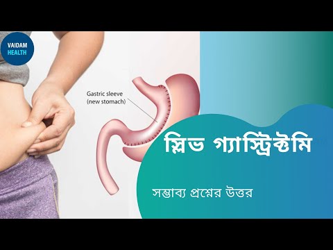 অস্ত্রোপচারে ওজন হ্রাস - প্রায়শই জিজ্ঞাসা করা প্রশ্ন (স্লিভ গ্যাস্টারেক্টমি)