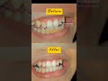 Tooth cleaning for a brighter smile 😁🦷🦷 #dentistry #dentalcare #oralcare #oralhealth #teeth #smile