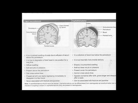 Cephalohematoma and Caput succedaneum - Short lacture