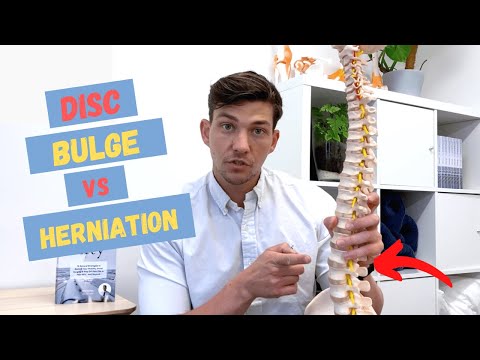 Bulging Disc vs Herniated Disc – What's the Difference?