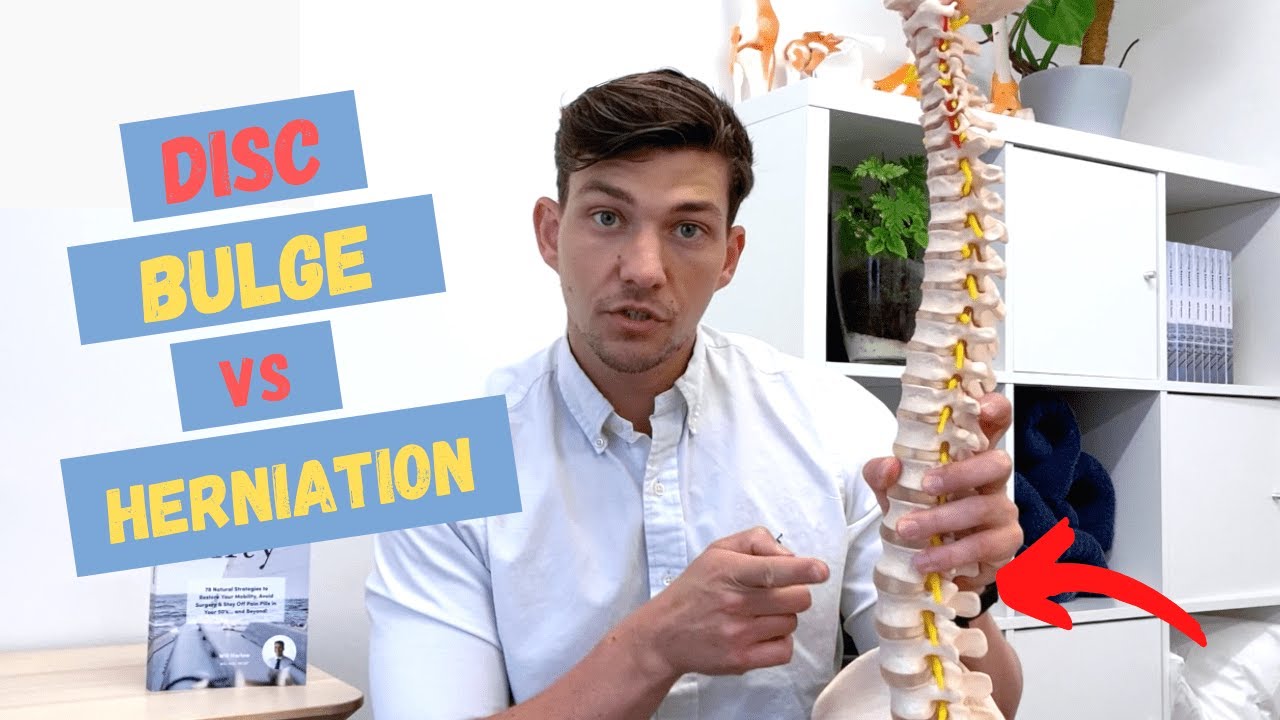 Bulging Disc vs Herniated Disc – What's the Difference?