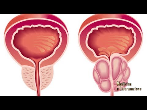 Cancer de prostata medidas de prevencion