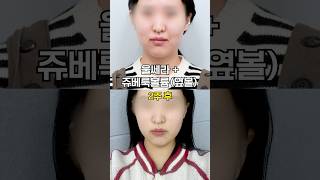 효과 좋은 피부시술 조합