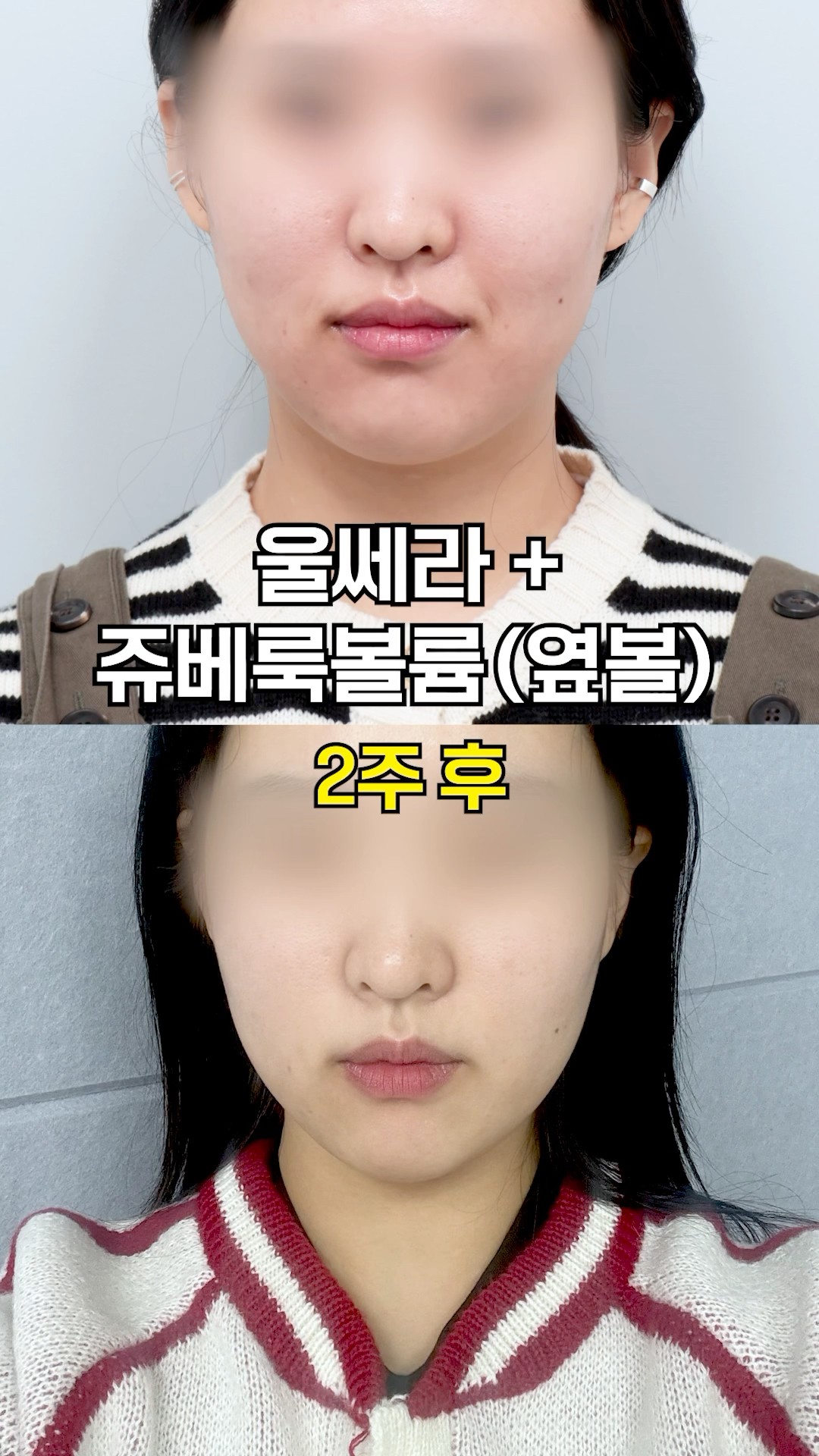 효과 좋은 피부시술 조합