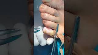 CIRUGÍA HELOMA INTERDIGITAL, 5° DEDO (OJO DE GALLO)