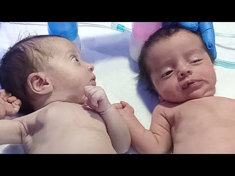 Twin Newborn Feeding Protocol in NICU | Chest Complications Care | Neonatal Nursing