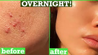 HOW TO GET RID OF ACNE, PIMPLES, TINY BUMPS ON FACE OVERNIGHT | Simple Home Remedy (DIY Treatment)