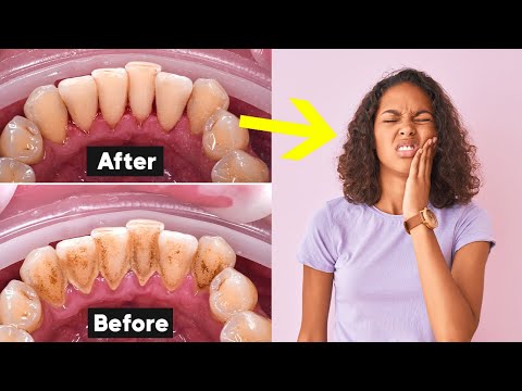 Deep Teeth Cleaning Recovery Tips (How To Heal Fast)