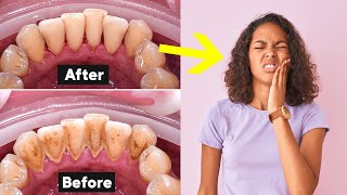 Deep Teeth Cleaning Recovery Tips (How To Heal Fast)