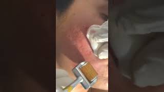 Do You Need A Derma roller For Acne Scar? | Viral #shorts
