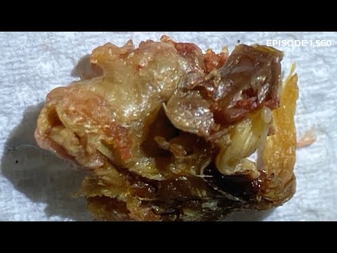 1,560 - Complex Grade III Keratosis Obturans Removal