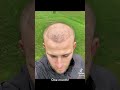 HAIR TRANSPLANT BEFORE AFTER - 11 MONTHS