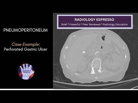 PNEUMOPERITONEUM: Case Example – Pneumoperitoneum on CT, Perforated Gastric Ulcer