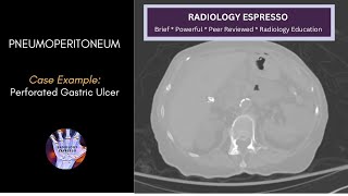 PNEUMOPERITONEUM: Case Example – Pneumoperitoneum on CT, Perforated Gastric Ulcer