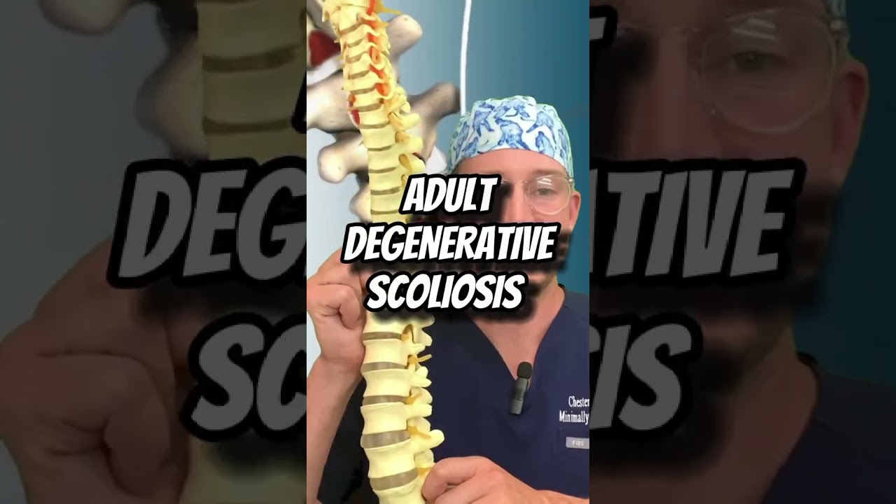 LEARN 2 types of SCOLIOSIS from a Spine Surgeon