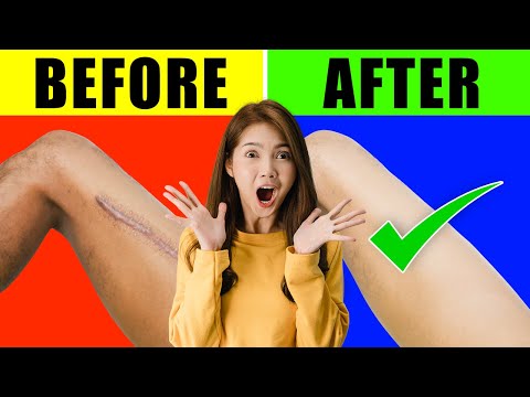 How To Remove Scars On Legs Fast Naturally | How to Remove Old Scars At Home