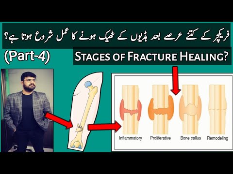 What are the 5 Stages Of Fracture Healing? || کتنی دیر بعد ہڈی کا فریکچر ٹھیک ہونا شروع ہوتا ہے؟
