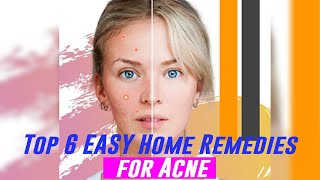 Top 6 EASY Home Remedies for Acne