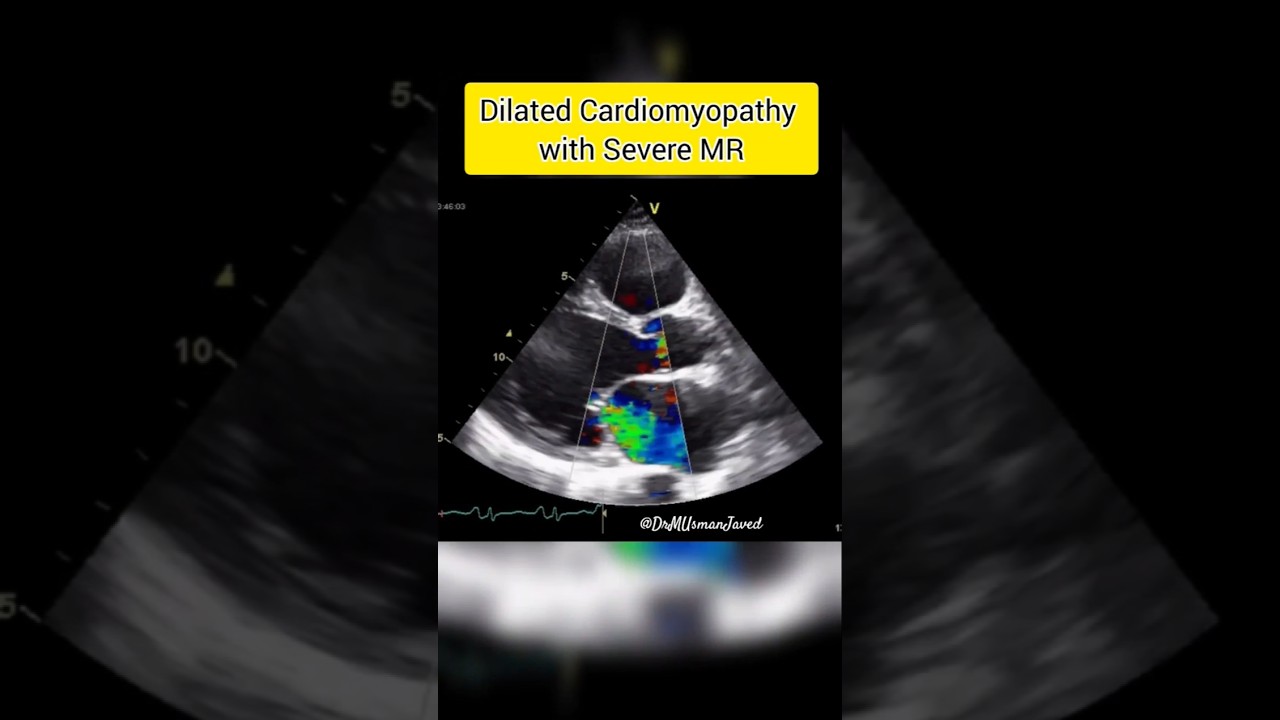 Dilated Cardiomyopathy DCM with Severe MR #mitralvalve #heart #Cardionotes
