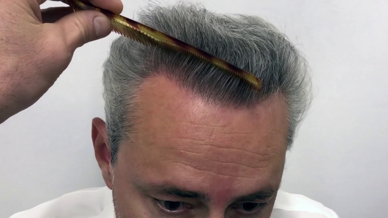 Watch Implante capilar a los 50 años en Capilea Now Implante capilar a los 50 años en Capilea