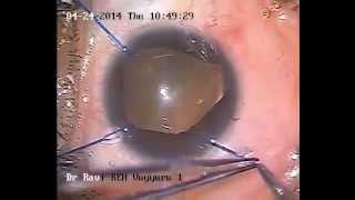 preview picture of video 'coloboma repair +  Phaco + foldable IOL'
