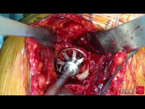 Ausrüstung Knee Replacement Ñ Ð½Ñ Ñ, Noe Ð ± оР»Ñ NOE ÑƒÑ Ñ, Ð ° вов d² ÐомР° ÑÐ½Ð¸Ñ ÑƒÑ ... л Ñ ... овиÑ