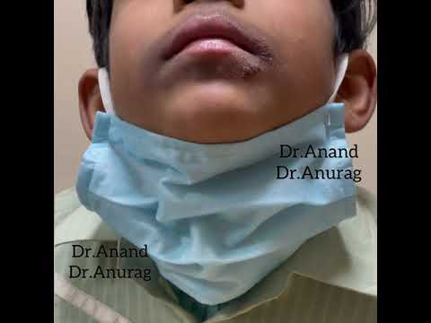 Pediatric Dermatology By Dr.Anand & Dr.Anurag - Lip Licker Dermatitis