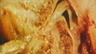 TMJ Anatomy "The Yoint" Video