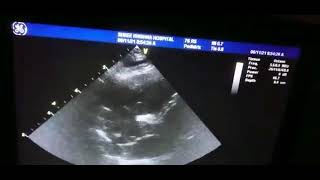 Post - operative Bedside Echocardiography for Fallot's Tetralogy Utilizing PVI