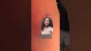 Flesh-Eating Bacteria Cases Rise After Hurricane Ian