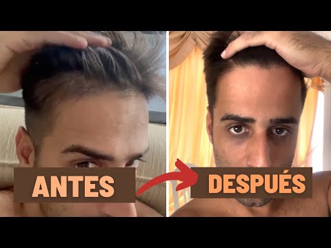 ASÍ RECUPERE mi PELO y ENTRADAS naturalmente – ANTES Y DESPUÉS
