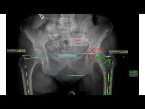 Manual Hip Plan in mediCAD 2D